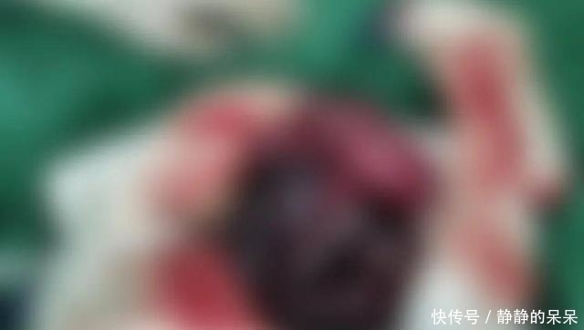 坏死|男孩饭后做了这个动作，一肚子小肠全变黑，15米小肠被切除