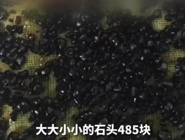 急性胰腺炎|小伙体内取出密密麻麻485块黑石头，原因竟是…春节千万警惕！