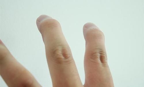 肺癌患者|肺癌早发现治愈率较高，身体早期发出的“信号”，要及时抓住