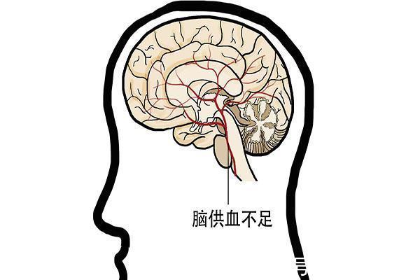 脑部|脑供血不足的人,大多有以下六个现象,还是小心为好