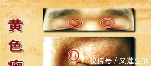 降血脂|天然“他汀”放1勺，连喝15天，专攻高血脂、疏通血管、血栓不来