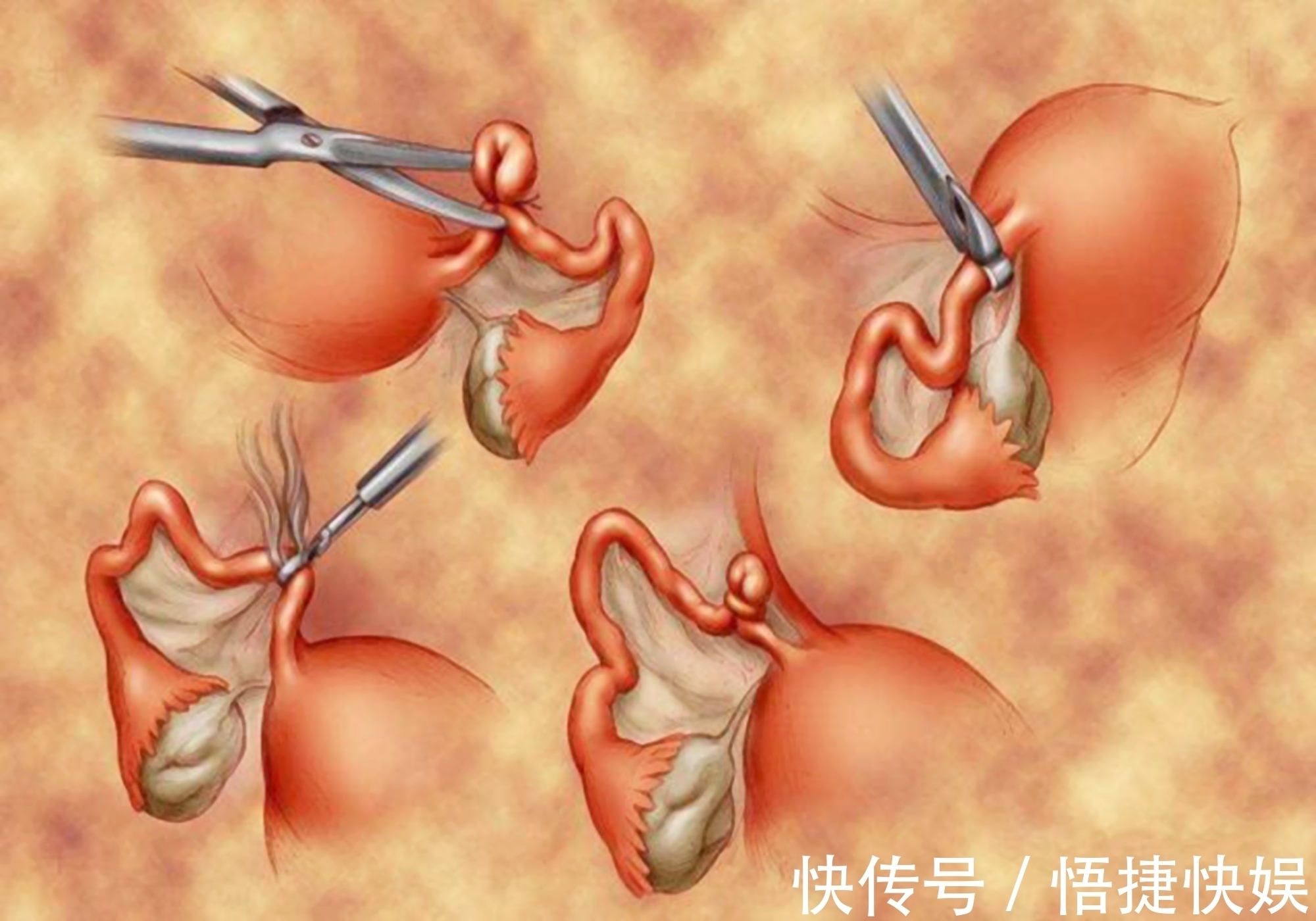 避孕|生一胎后上环,为生二胎取环,医生多亏生二胎的想法救了你