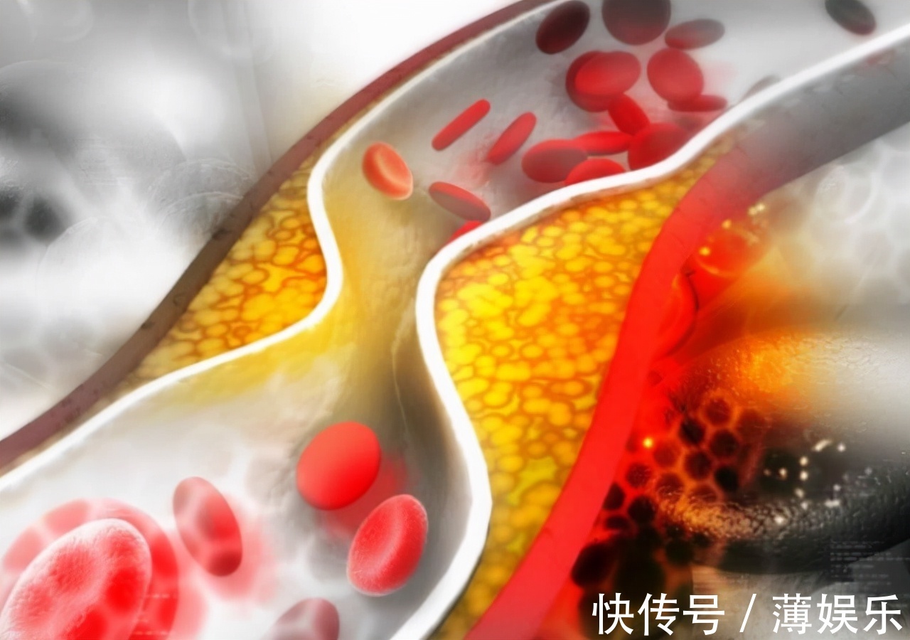 油脂|多走路能降血脂医生提醒日常多吃这4物，或比走路效果好