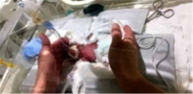 孕妇|还记得世界上“最小婴儿”吗?网友都期待她长大模样,如今她来了
