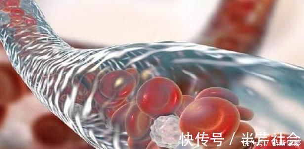 专家|血管堵塞导致血栓,专家每天坚持做两个动作,全身血液通畅