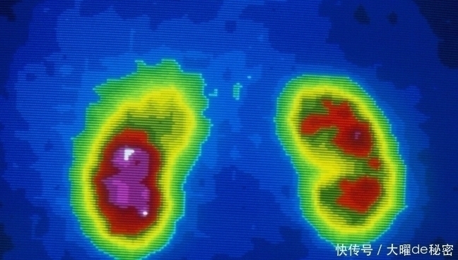 糖尿病肾病|尿毒症和肾功能衰竭跟糖尿病有什么关系?留意这4大症状