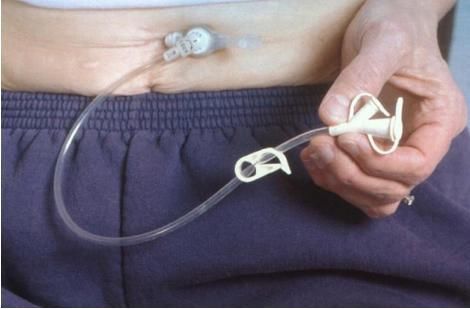 记号|偷偷给病人肚皮上画了一个圈，避免了外科医生被大佬骂惨