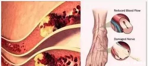 酸痛|血管堵没堵，弯腰摸1个地方就知道，1个小动作，将血栓冲走