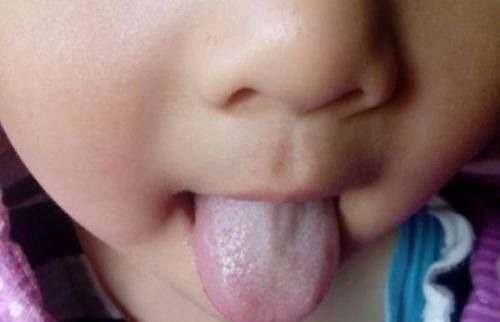 脾虚|儿科医生提醒:孩子积食不长个,少吃3种水果,养护脾胃消积食