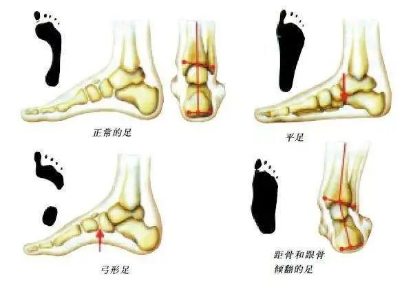 儿童平足最佳矫正时间