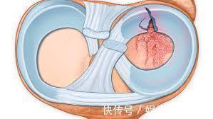 患者|膝盖疼,就是得滑膜炎了?医生辟谣,教您一步步判断自己的病因