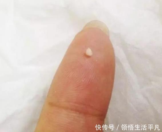 鼻子上挤出来的白色物体是什么皮肤科医生给出这些忠告