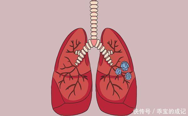 甲状腺结节|体内长结节的人，不管长在哪个部位，3种食物尽早拉入黑榜