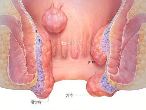 红霉素软膏|红霉素也能治痔疮？相关部门做了抽样调查！真实结果出人意料！