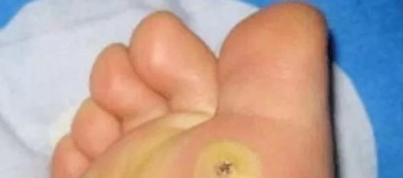 茧子|脚上长“茧子”和疾病有关?若脚上出现4种茧子,一定要留意了!