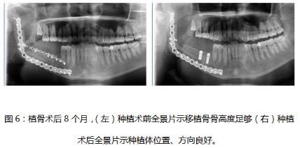 种植|市中心医院口腔科成功完成一例下颌骨成釉细胞瘤扩大切除后双层腓骨移植联合牙种植手术