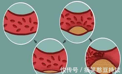 食物|胆固醇高,不能吃鸡蛋?医生:真正不该吃的是3物,不要吃错了