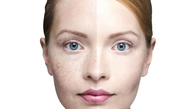 脸上长斑是怎么回事？可能和以下这几大因素有关？