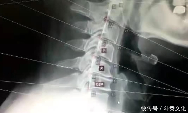 肩膀疼痛,并非肩周炎,问题在哪?您找对没?此文给您全新的认识