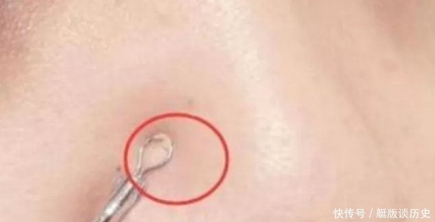 挤出|鼻子上挤出“白色条状物”?学会这3招,从此告别“草莓鼻”!