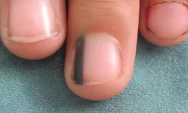 医生|指甲上有黑线,可能是最恶的癌症,医生教你怎么办