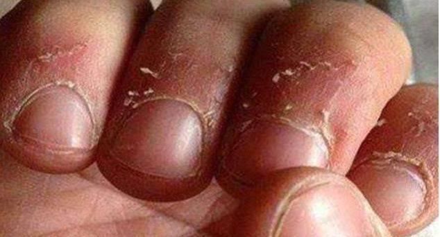 家长|孩子手上经常出现“倒刺”,家长着急,可能是3个原因引起的