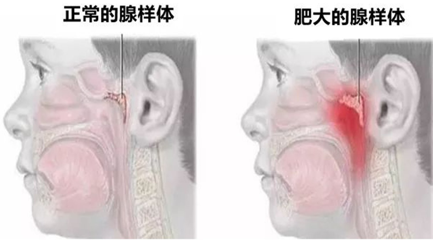 扁桃体|睡觉时一个坏习惯，会让孩子越长越丑，父母别任其发展