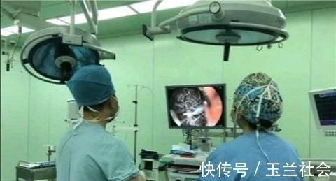 孩子|16个小时“拉丝”手术,用坏6把异物钳!心疼,3岁女孩胃里取出两袋头发