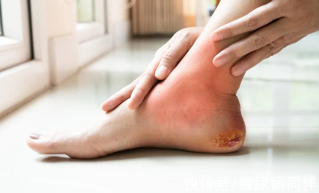 糖尿病|糖尿病人有四个症状,当心引发足病造成截肢