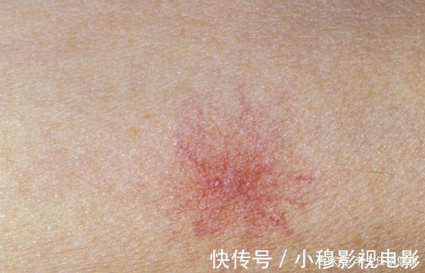 不良习惯|肝病发现即晚期?身体出现这3种异常后,或是肝病前兆,莫忽视