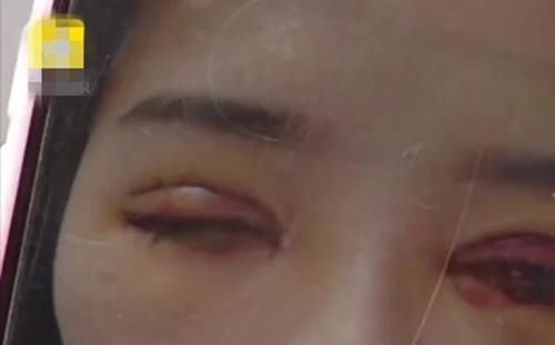 女子想做双眼皮，整形过后眼睑缺了一块，医院：不算整形失败