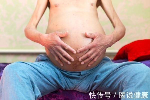 肝硬化|身体出现5种迹象,当心肝硬化或已找上门,要提高警惕