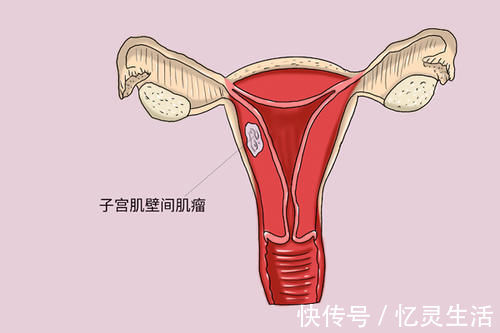 妇科医生|查出子宫肌瘤，没接受治疗，结果会怎么样？妇科医生说出了实话