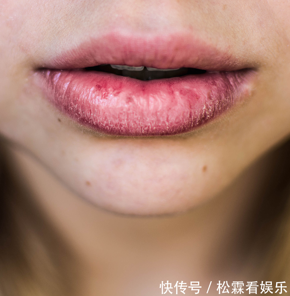 嘴唇|女性有没有妇科疾病,看嘴巴就能够知道,三个特征一眼就能分辨