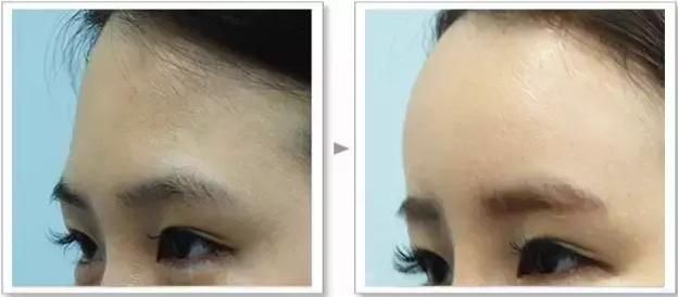 面部凹陷太显老，想要变回少女脸，你得这样做！