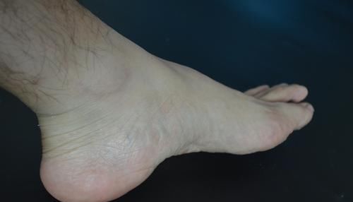  脚后跟干裂脱皮不用愁，教你一个土方法，轻松解决，省钱又实用