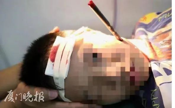 嘶！看着就疼！厦门11岁男孩脸上插进一支铅笔，只因这个小动作……