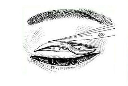 眼部 全切双眼皮多久能恢复正常?术后效果怎么样?快来看看吧