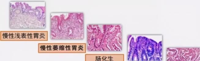 内镜|胃镜查出来“上皮内瘤变”,是癌吗?该怎么办?