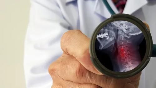 颈部|都是颈椎病，感觉不同型号不一样！弄清楚自己是哪种才能对症治疗