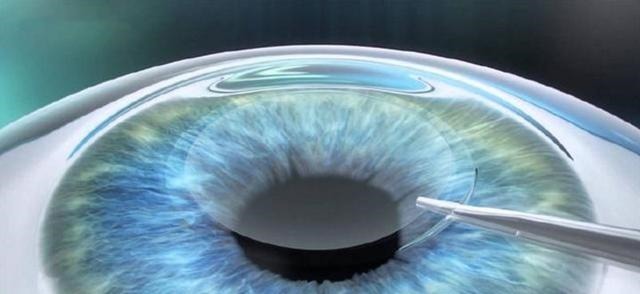 眼角膜|那些做了激光近视手术的人, 后来怎么样了 来听听过来人怎么说!