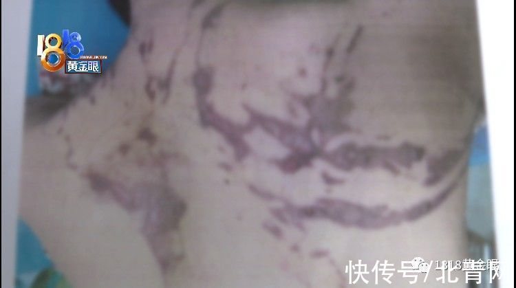 朱老板|姑娘拔火罐，后背起了火