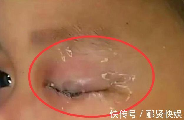 胶水|儿子误拿胶水滴眼睛,宝妈用30秒保住了娃眼睛,医生饭碗不保了