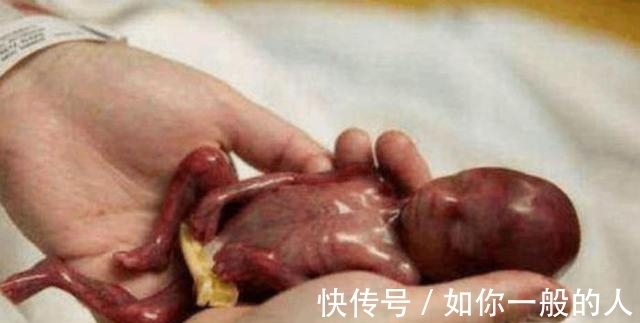 婴儿|在妈妈肚子里呆了22周，出生体重仅有245克，世界最小婴儿