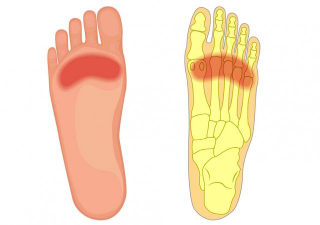 足部|一份“双脚疼痛图解”，详解不同位置脚疼原因