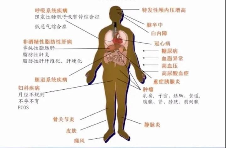  睡着|睡着睡着就被送进ICU急救！30多岁的他，体重300多斤，两次死里逃生