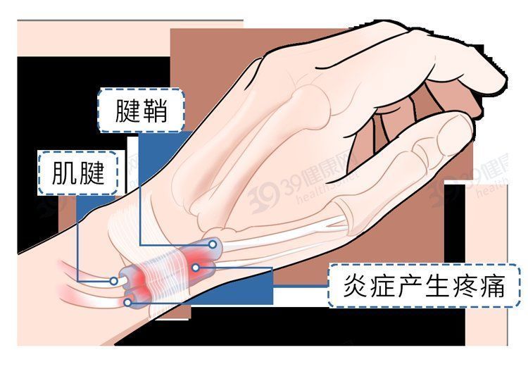 折磨|常年折磨女性的腱鞘炎，是怎么产生的？如何治疗？告诉你详细方法