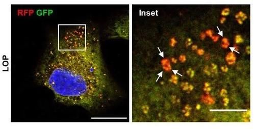 【新进展】老药新用!抗腹泻药开启细胞自噬开关,驱使癌细胞死亡