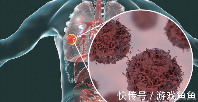 甲状腺癌|癌症患者都是被治死的?癌症晚期的治疗就是陷阱?医生告诉您真相