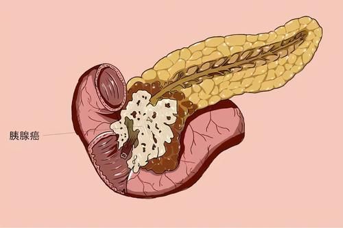 胰腺癌|胰腺癌生存率低，不易被发现，提醒：早期的3个症状，你没当回事